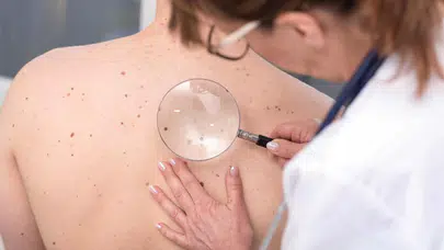 Cilt Kanserinin 6 Belirtisine Dikkat!
