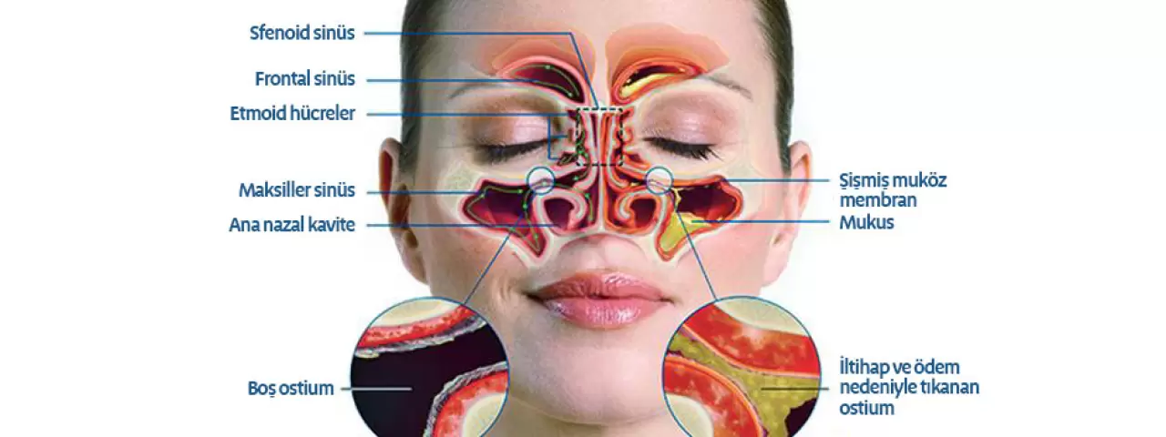 Kronik Sinüzit, baş ağrısı ve burun tıkanıklığına yol açarak yaşam kalitesini düşürebilir. Uzmanlar, sinüzit tedavisi ve cerrahi müdahale hakkında bilmeniz gereken her şeyi açıkladı. İşte detaylar..